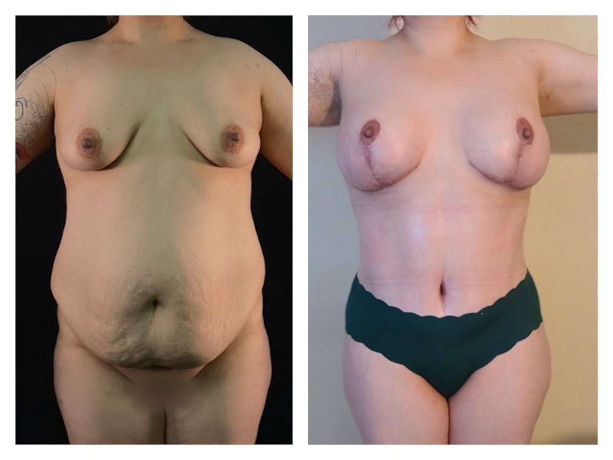 Liposuction Before & After Gallery - Patient 175515127 - Image 1