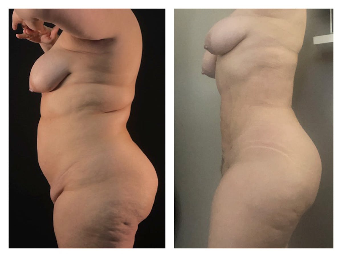 Liposuction Before & After Gallery - Patient 175515126 - Image 1