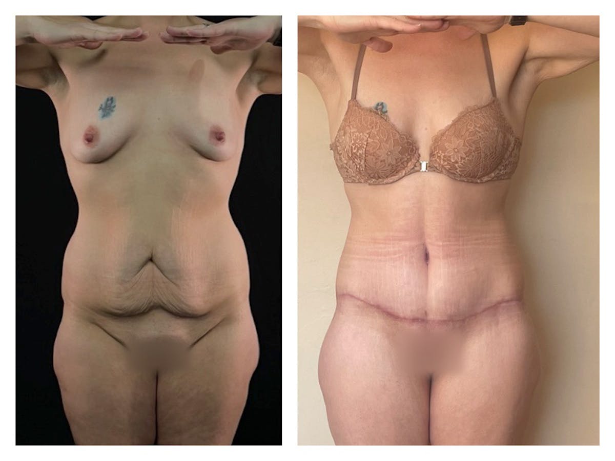 Liposuction Before & After Gallery - Patient 175515124 - Image 1