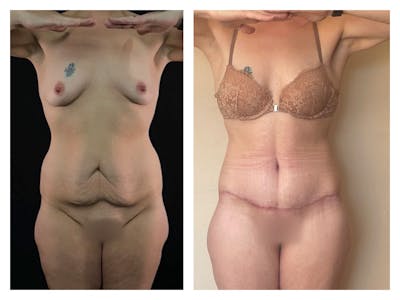 Liposuction Before & After Gallery - Patient 175515124 - Image 1