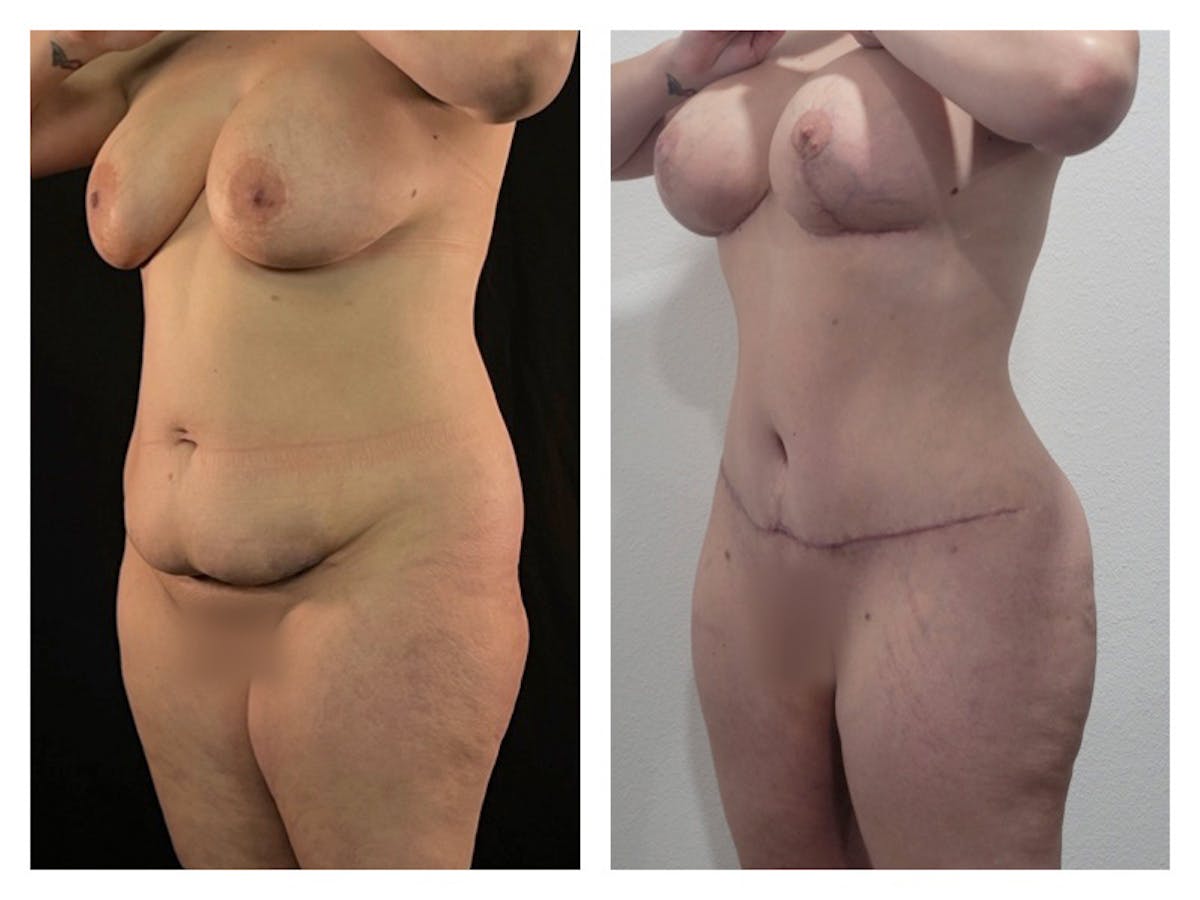Liposuction Before & After Gallery - Patient 175515123 - Image 1