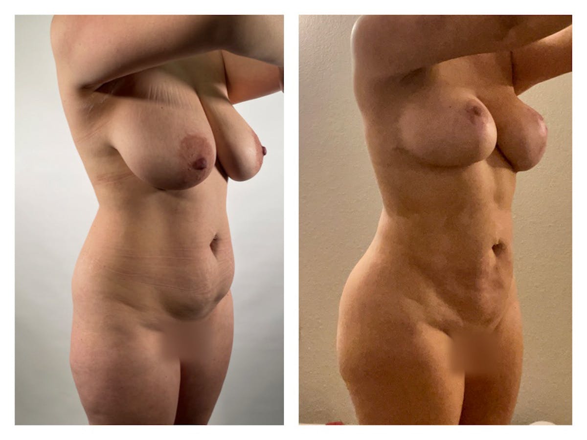 Liposuction Before & After Gallery - Patient 175515121 - Image 1