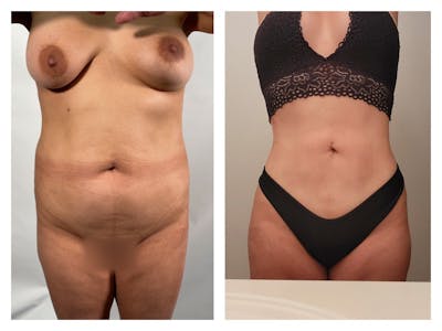 Liposuction Before & After Gallery - Patient 175515120 - Image 1