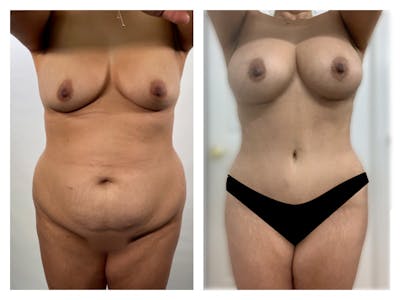 Tummy Tuck Before & After Gallery - Patient 175518054 - Image 1