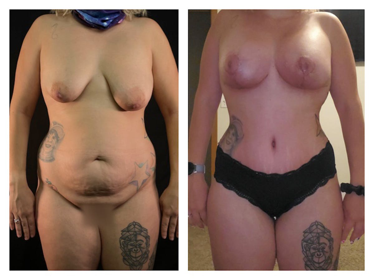 Tummy Tuck Before & After Gallery - Patient 175518050 - Image 1
