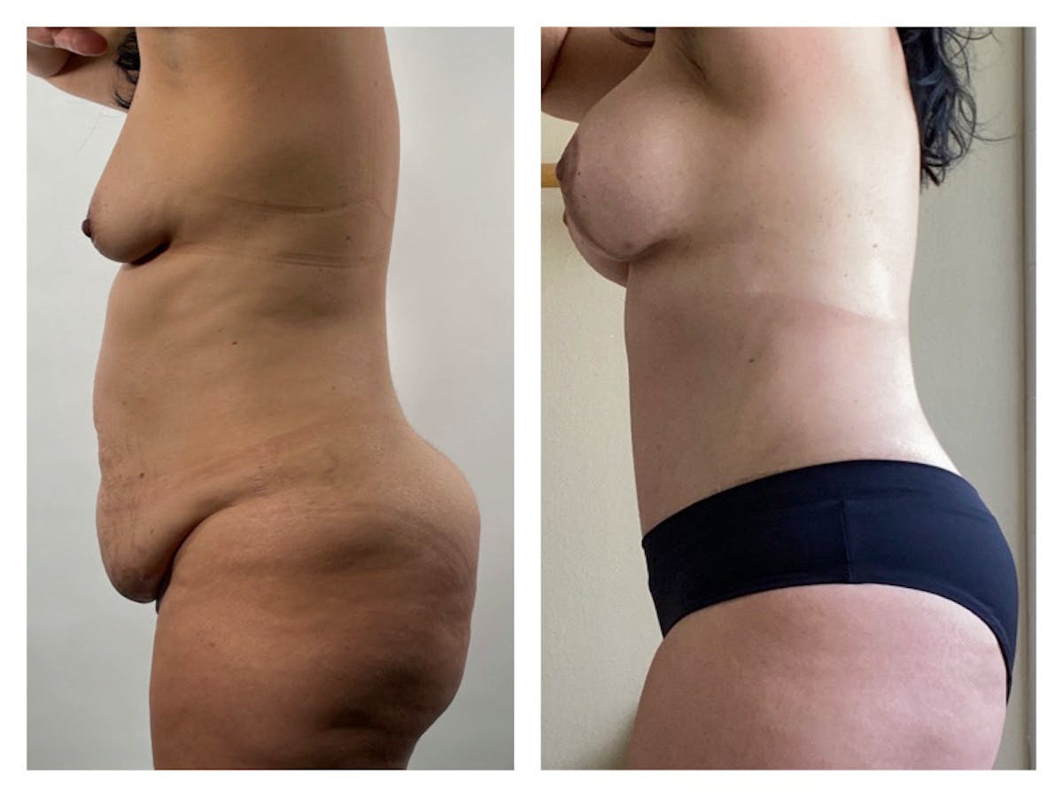 Tummy Tuck Before & After Gallery - Patient 175518048 - Image 1