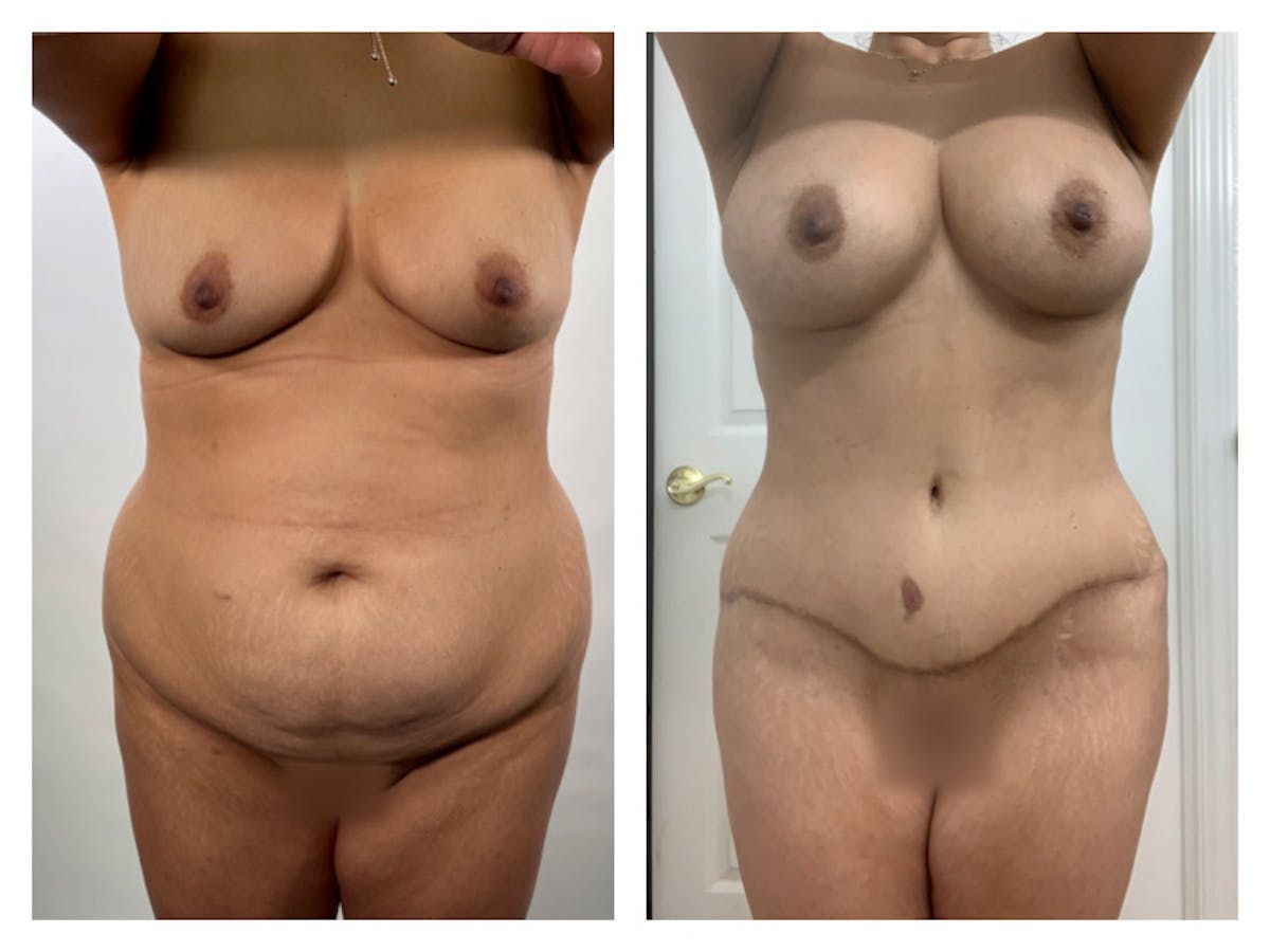 Tummy Tuck Before & After Gallery - Patient 175518047 - Image 1