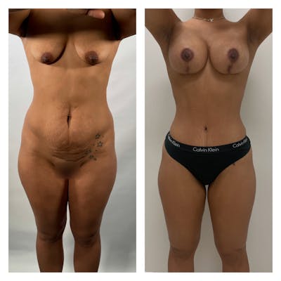 Tummy Tuck Before & After Gallery - Patient 175518046 - Image 1