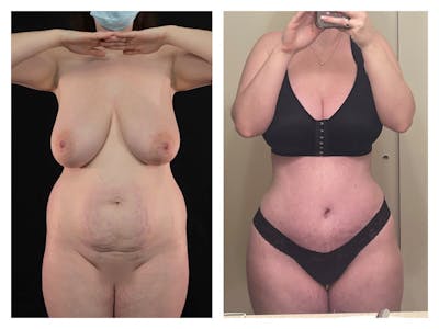 Tummy Tuck Before & After Gallery - Patient 175518045 - Image 1