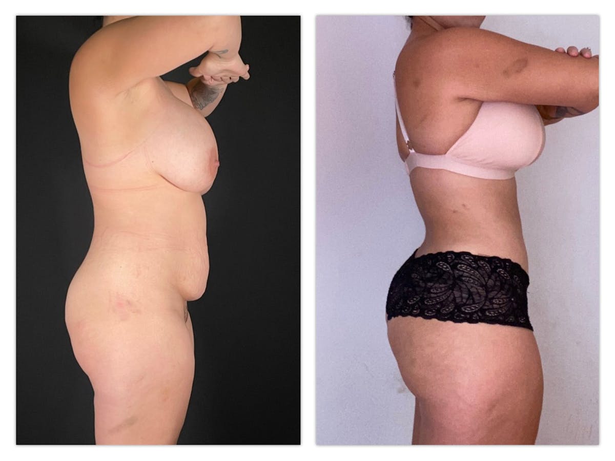Tummy Tuck Before & After Gallery - Patient 175518044 - Image 1
