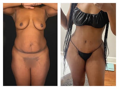 Tummy Tuck Before & After Gallery - Patient 175518043 - Image 1