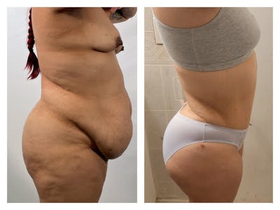 Tummy Tuck Before & After Gallery - Patient 175518039 - Image 1