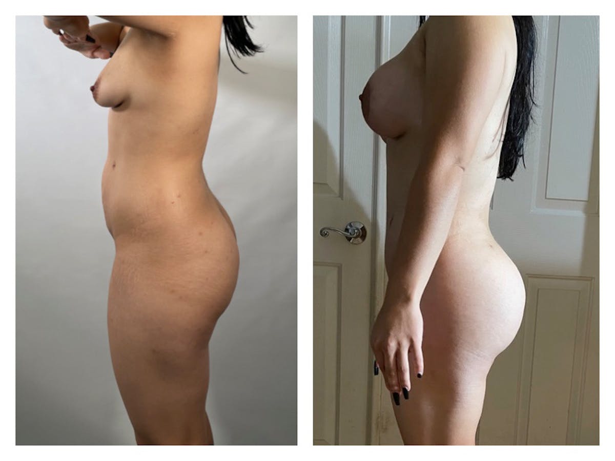 Tummy Tuck Before & After Gallery - Patient 175518038 - Image 1