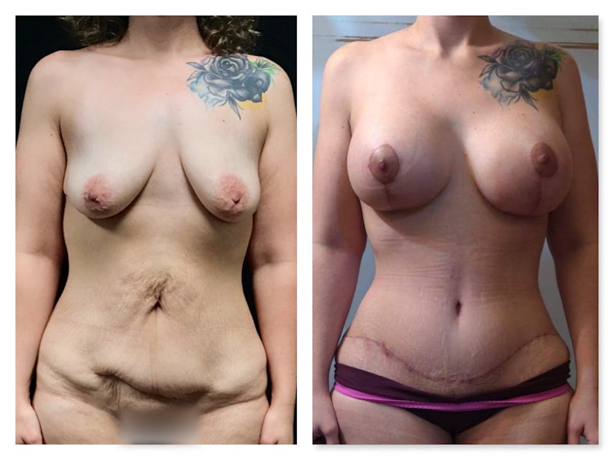 Tummy Tuck Before & After Gallery - Patient 175518037 - Image 1
