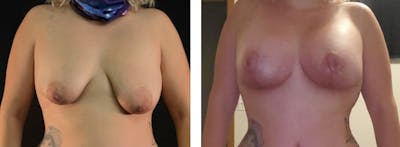 Breast Augmentation Before & After Gallery - Patient 175518063 - Image 1
