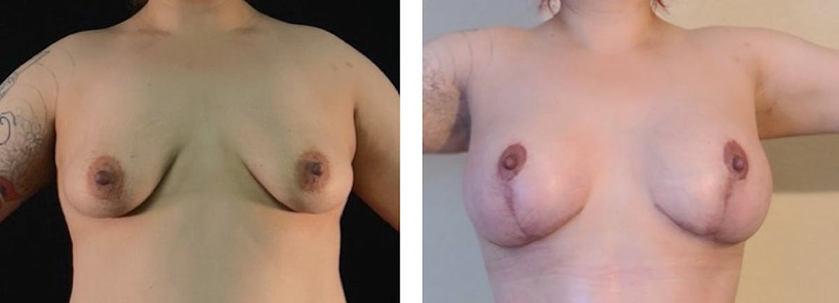 Breast Augmentation Before & After Gallery - Patient 175518062 - Image 1