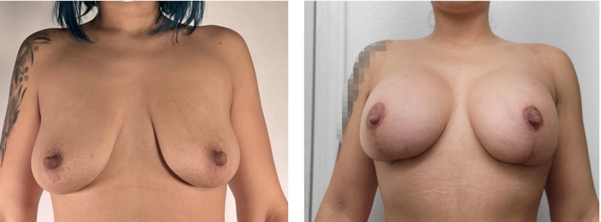 Breast Augmentation Before & After Gallery - Patient 175518061 - Image 1
