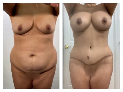 Breast Lift Before & After Gallery - Patient 175518069 - Image 1