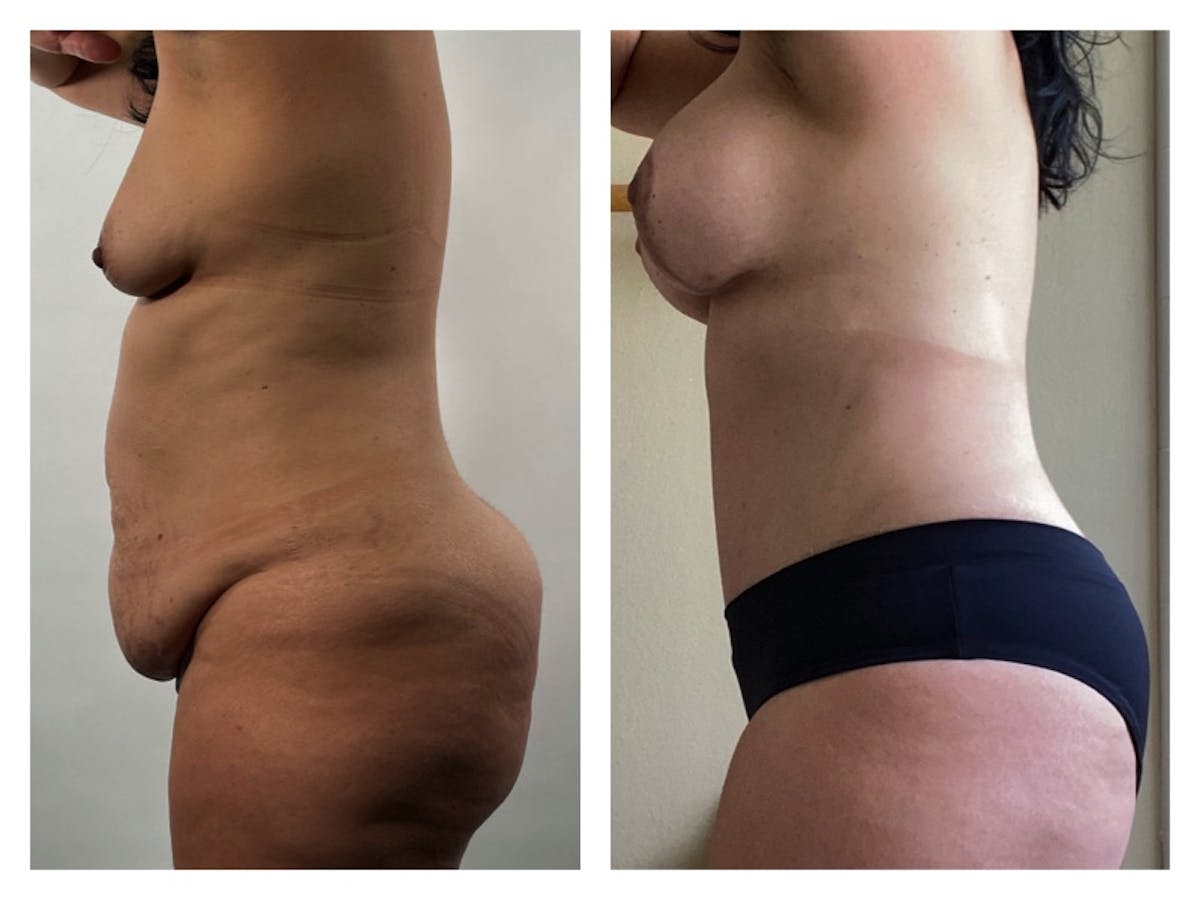 Breast Lift Before & After Gallery - Patient 175518071 - Image 1