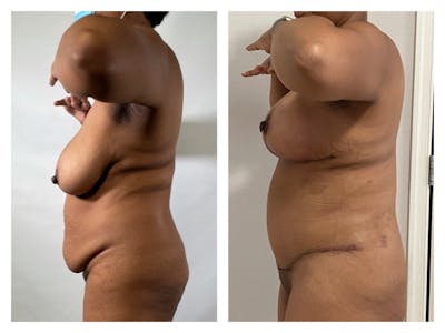 Breast Reduction Before & After Gallery - Patient 259278 - Image 1