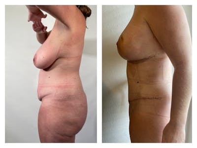 Breast Reduction Before & After Gallery - Patient 104266 - Image 1