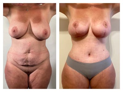 Breast Reduction Before & After Gallery - Patient 299897 - Image 1