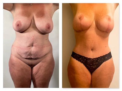 Breast Reduction Before & After Gallery - Patient 401389 - Image 1