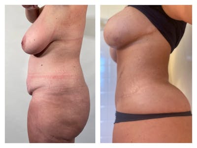 Breast Reduction Before & After Gallery - Patient 284625 - Image 1