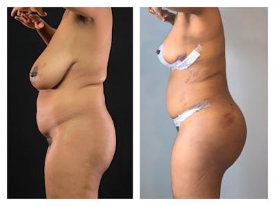 Breast Reduction Before & After Gallery - Patient 624253 - Image 1
