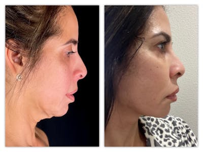 Facelift Before & After Gallery - Patient 415529 - Image 1