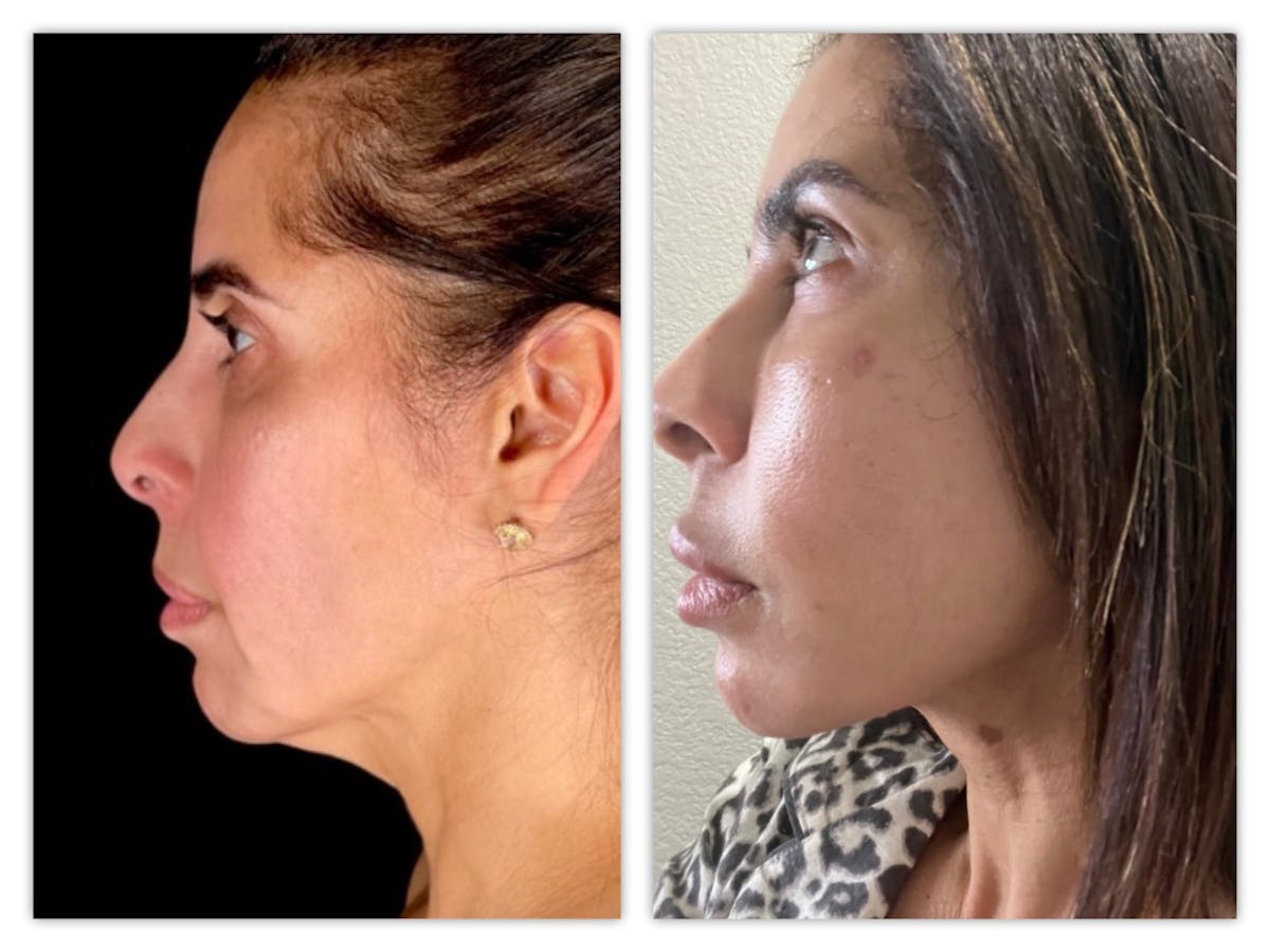 Facelift Before & After Gallery - Patient 415529 - Image 2