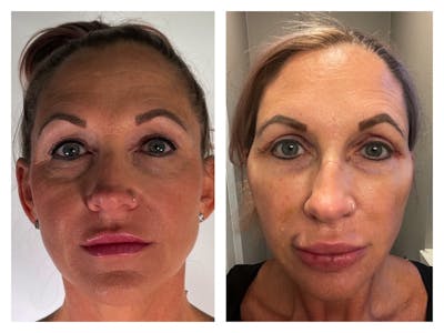 Facelift Before & After Gallery - Patient 115555 - Image 1