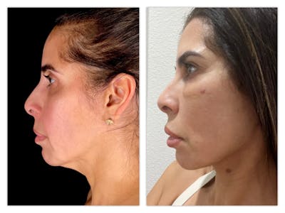 Neck Lift Before & After Gallery - Patient 283314 - Image 1