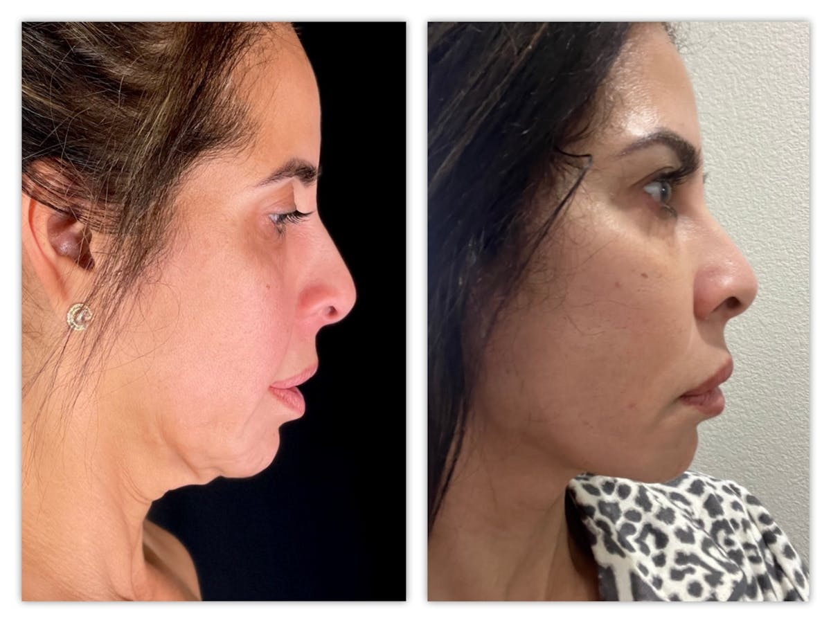 Neck Lift Before & After Gallery - Patient 283314 - Image 2