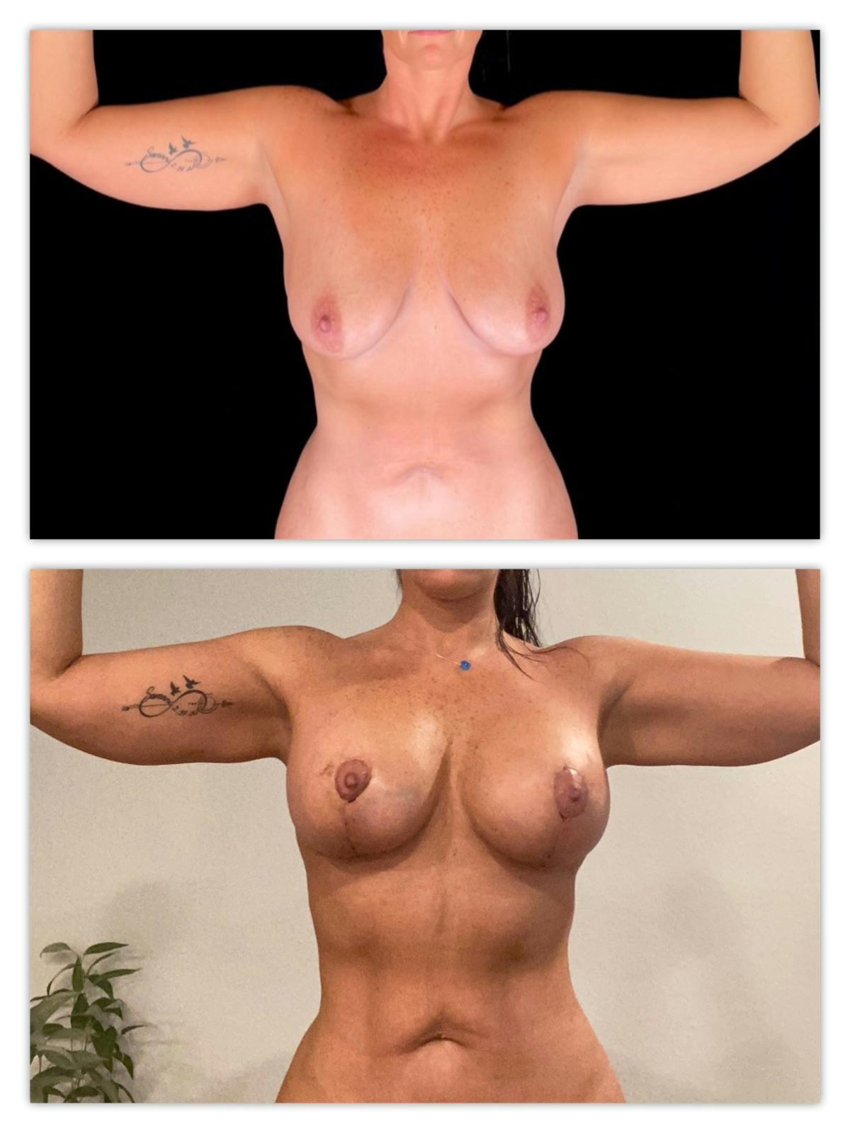 Breast Augmentation Before & After Gallery - Patient 407802 - Image 1