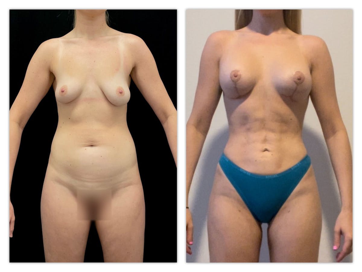 Breast Augmentation Before & After Gallery - Patient 320256 - Image 1