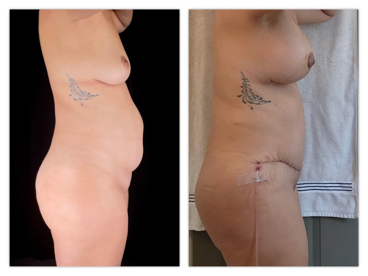 Breast Augmentation Before & After Gallery - Patient 145681 - Image 1