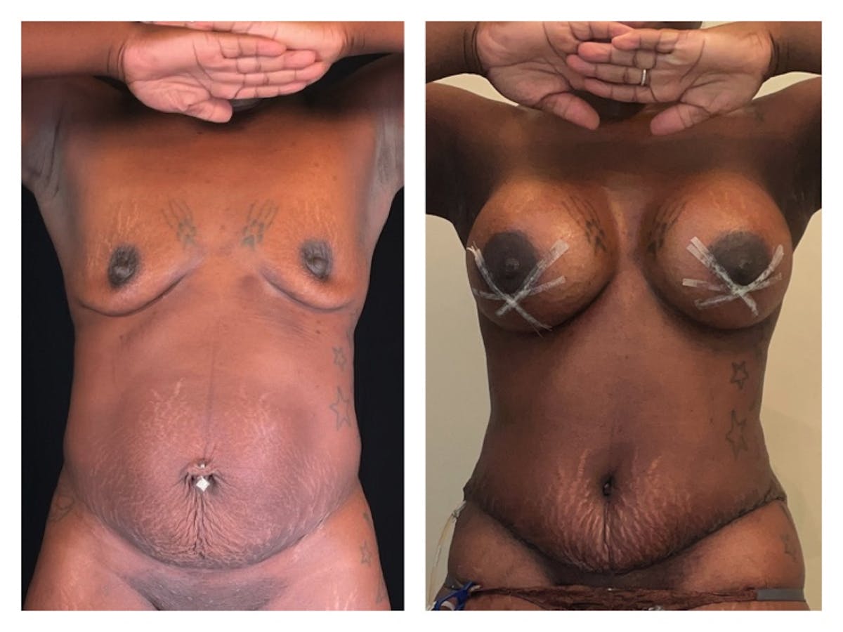 Breast Augmentation Before & After Gallery - Patient 354258 - Image 1