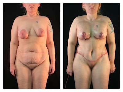 Mommy Makeover Before & After Gallery - Patient 133183867 - Image 1