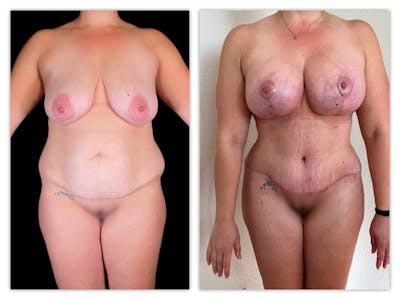 Mommy Makeover Before & After Gallery - Patient 133183843 - Image 1