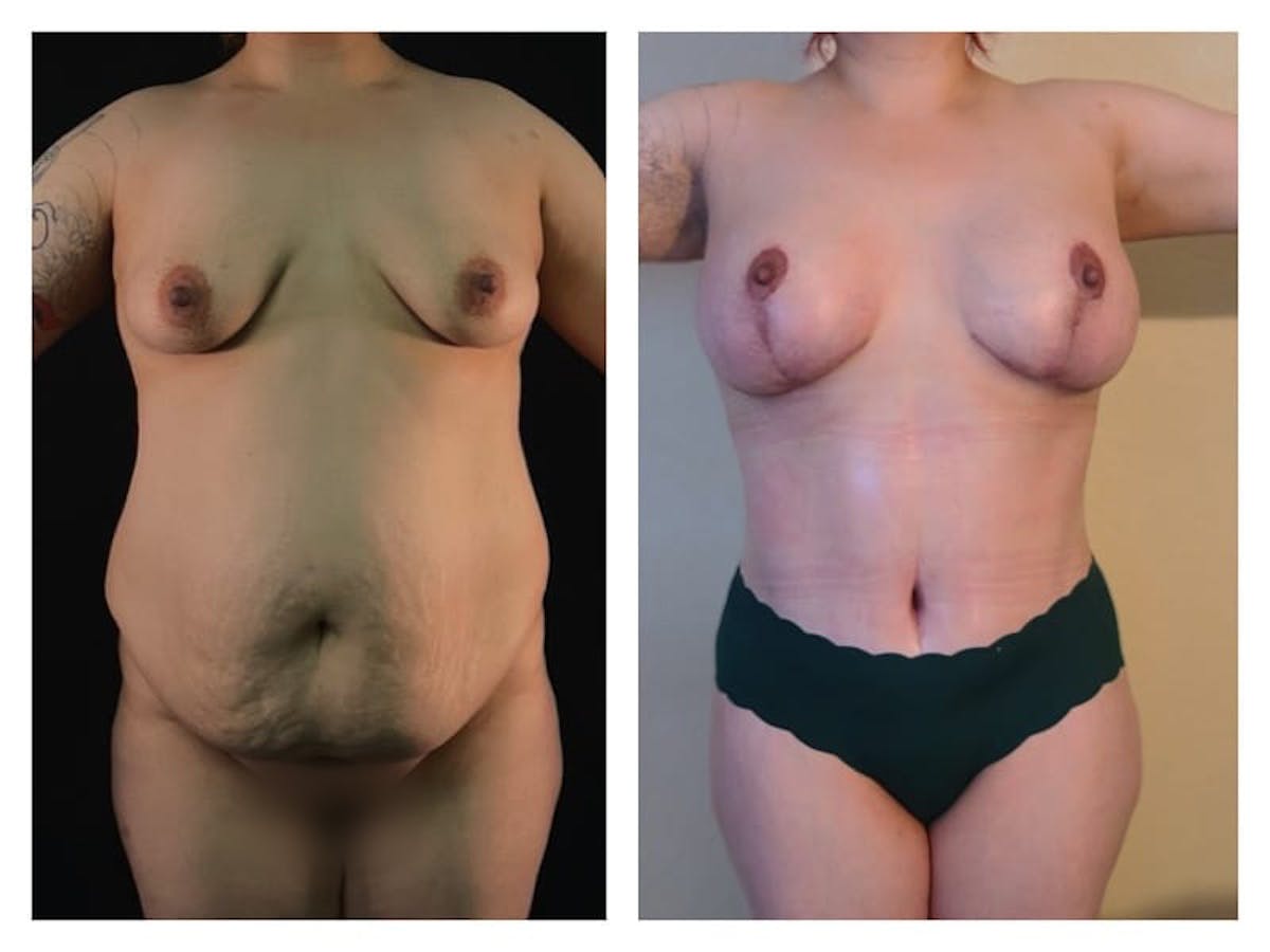 Mommy Makeover Before & After Gallery - Patient 133183788 - Image 1