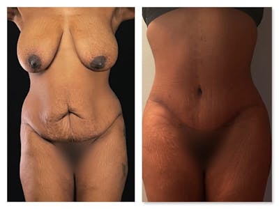 Tummy Tuck Before & After Gallery - Patient 133183894 - Image 1
