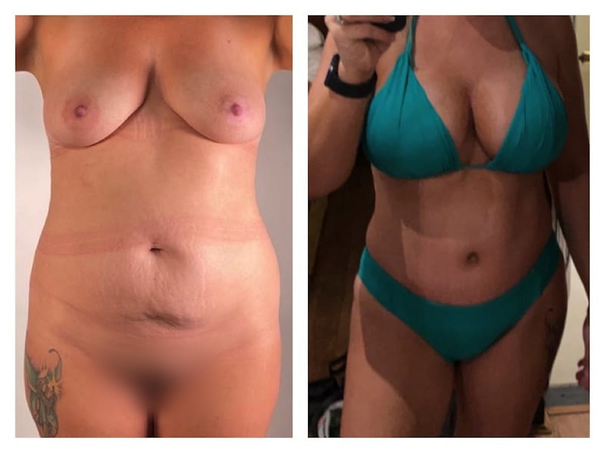 Tummy Tuck Before & After Gallery - Patient 133183888 - Image 2