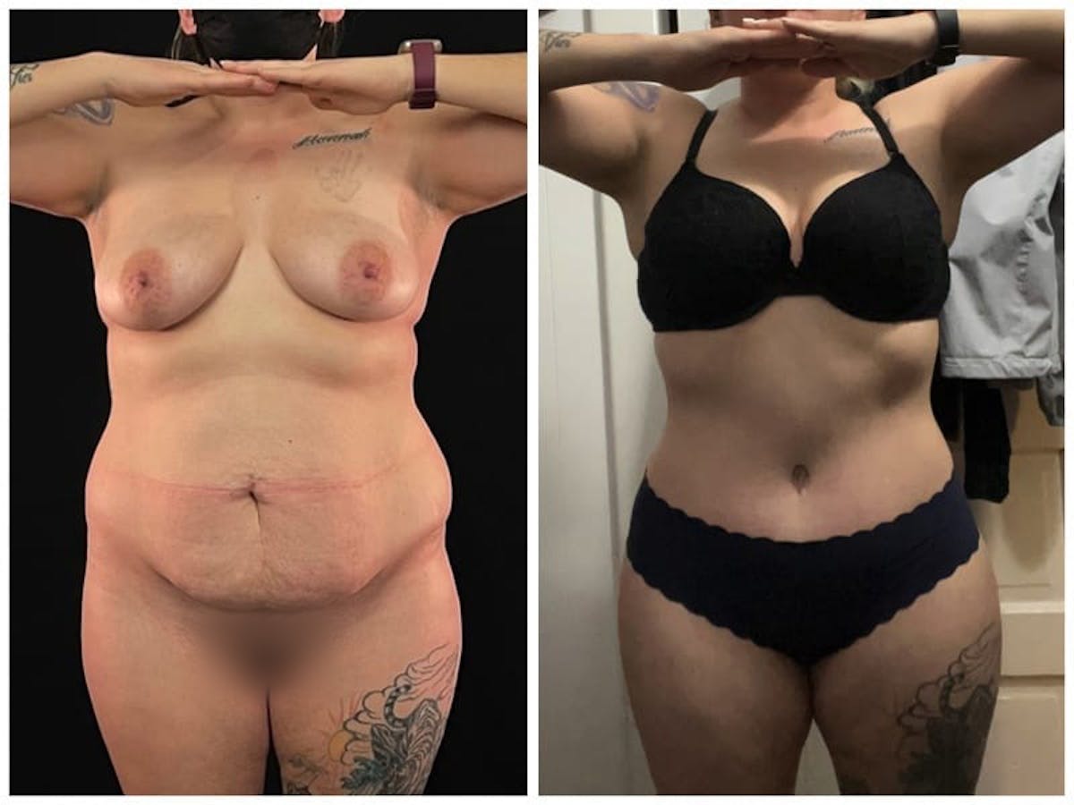Tummy Tuck Before & After Gallery - Patient 133183792 - Image 1