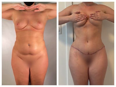 Tummy Tuck Before & After Gallery - Patient 133183659 - Image 1