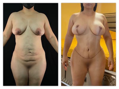 Tummy Tuck Before & After Gallery - Patient 133183615 - Image 1