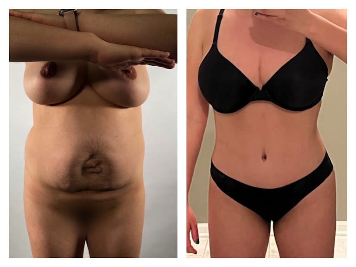 Tummy Tuck Before & After Gallery - Patient 133182986 - Image 1