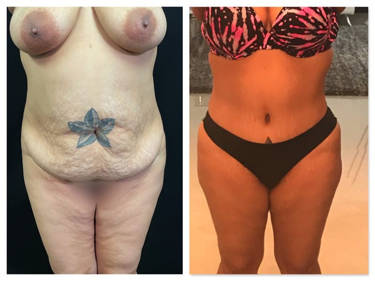 Tummy Tuck Before & After Gallery - Patient 133182983 - Image 1