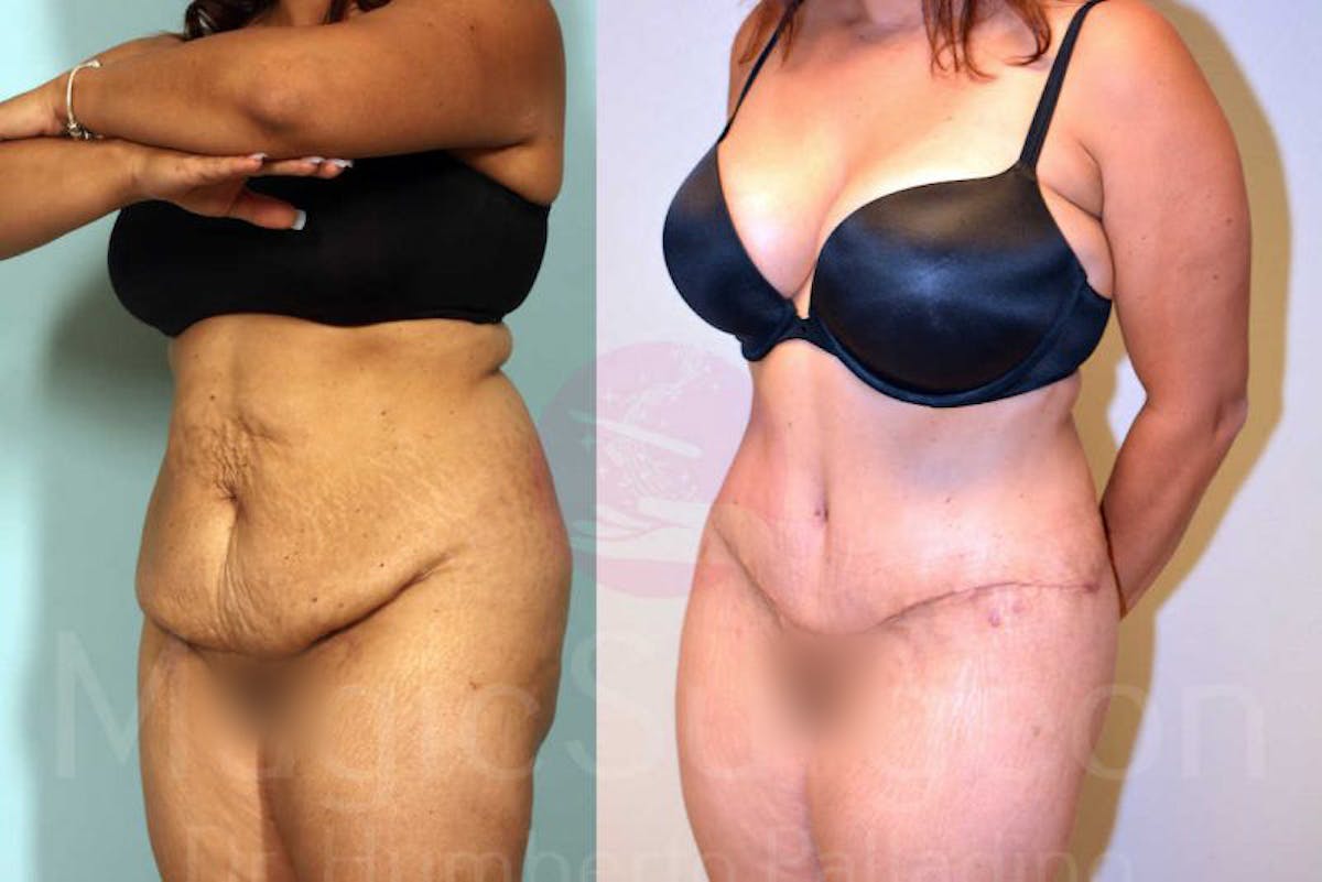 Tummy Tuck Before & After Gallery - Patient 133182332 - Image 4
