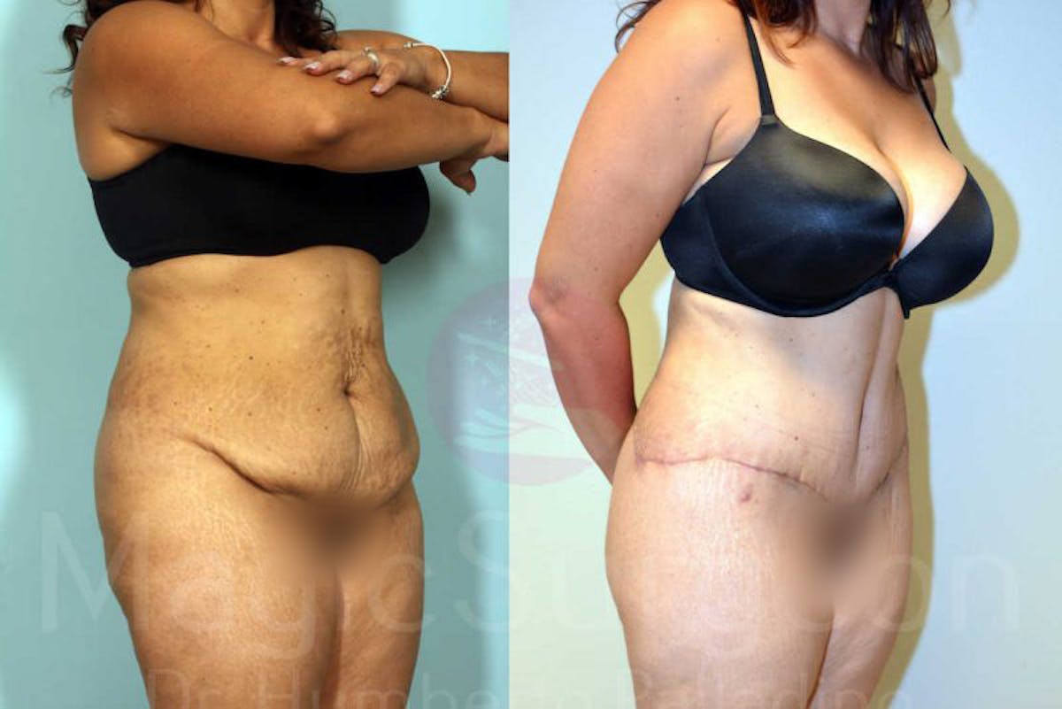 Tummy Tuck Before & After Gallery - Patient 133182332 - Image 2